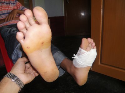 Feet of 13 year old boy bitten by otters.  The left foot has bruising and puncture marks across the instep jsut below the ball of the foot.  The right foot is bandaged.  Click for larger version.